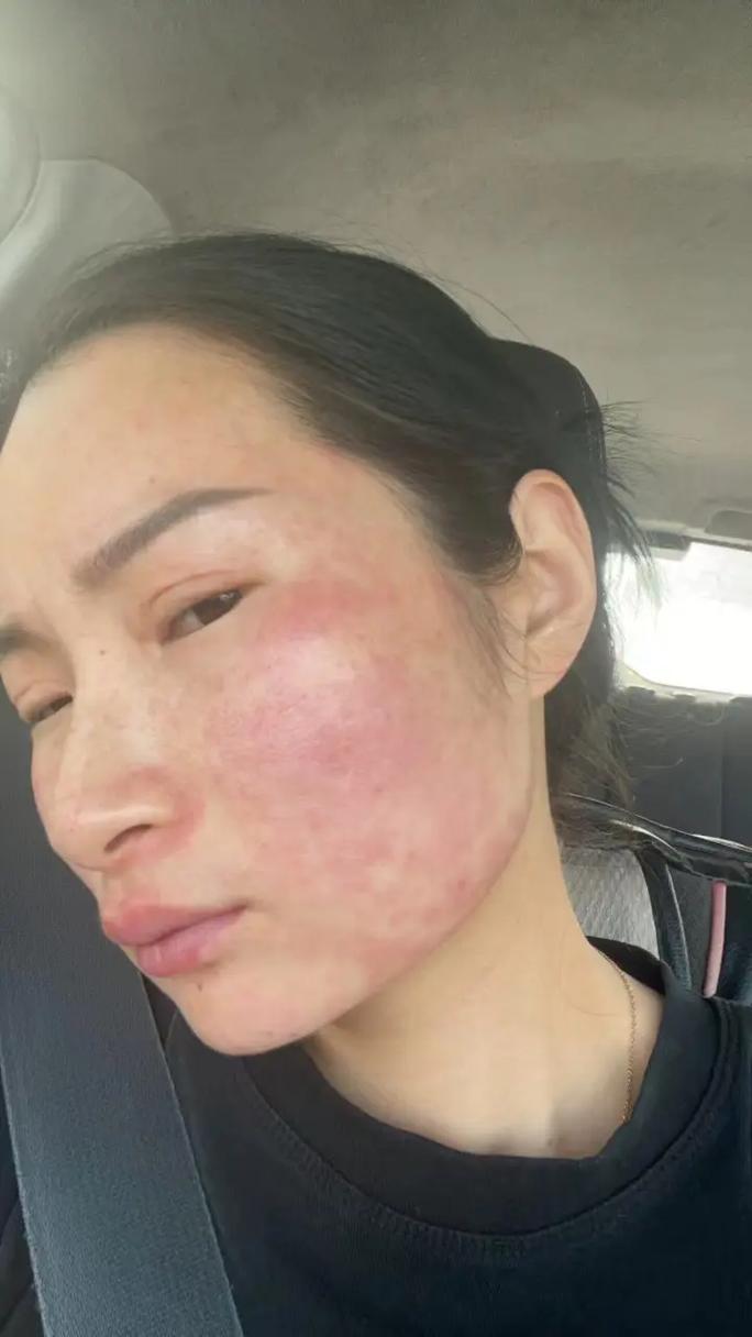 饮酒与皮肤问题