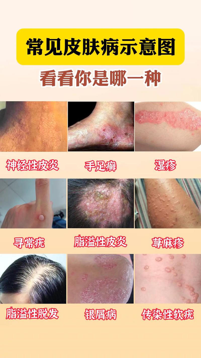 详细阅读:皮肤病:常见类型、病因、症状及防治全解析 皮肤病:常见类型、病因、症状及防治全解析