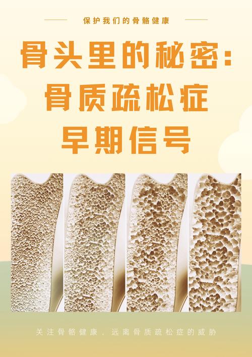 骨质疏松那些事儿