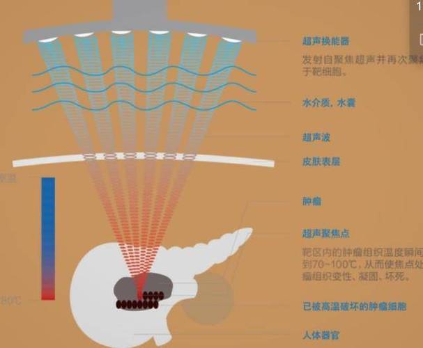 聚焦超声减脂技术原理全解析