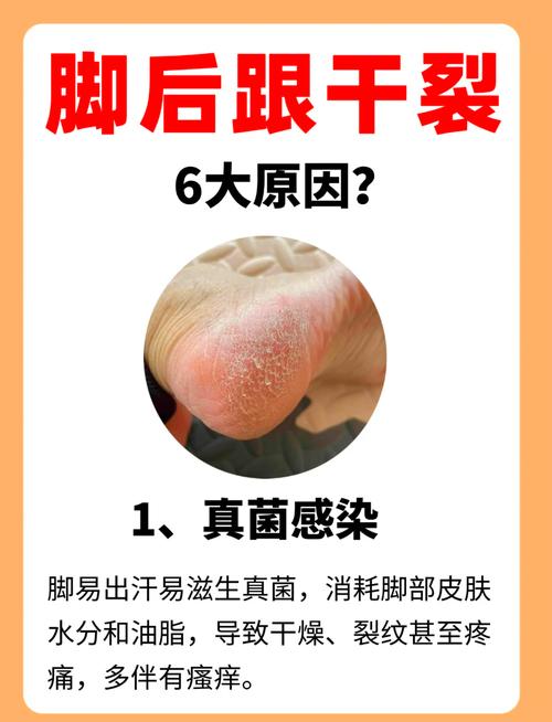 足部干裂修复全攻略：告别干裂，重获光滑肌肤