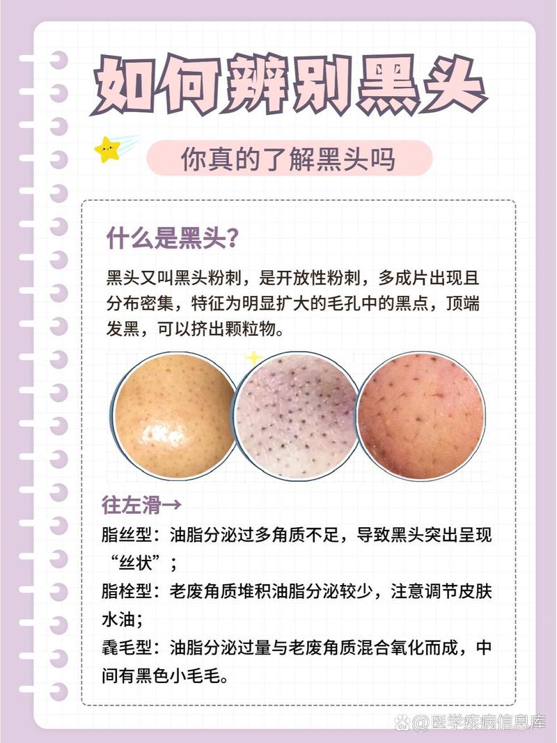 黑头仪的利弊分析