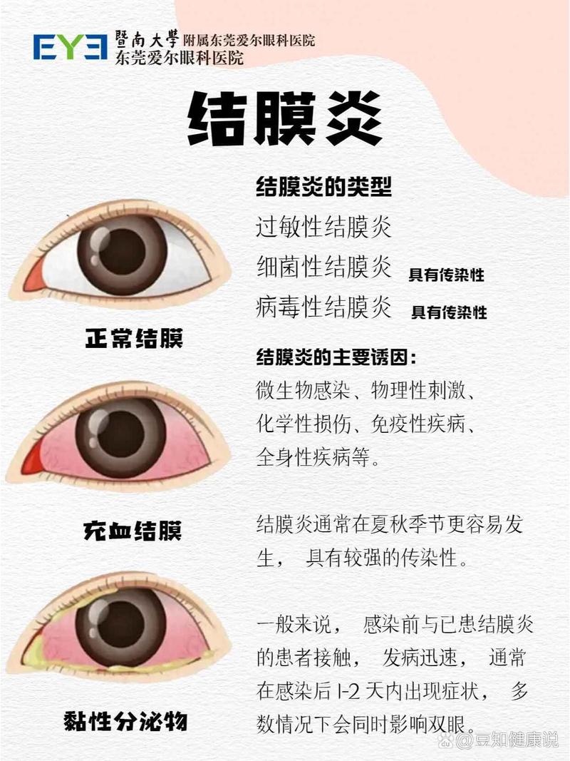 结膜炎的治疗