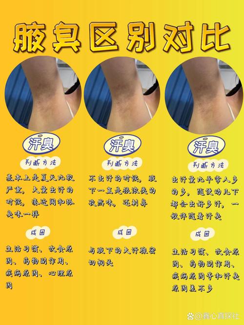 狐臭的治疗与改善