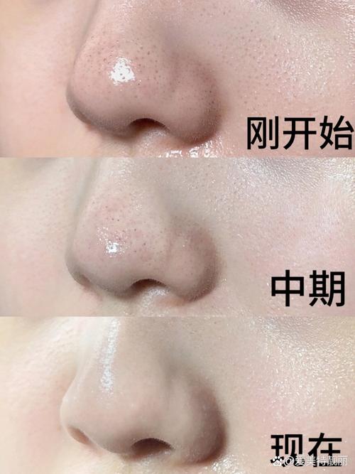 详细阅读:告别“草莓鼻”!黑头清理全攻略,让你的肌肤重焕清透光彩 告别“草莓鼻”!黑头清理全攻略,让你的肌肤重焕清透光彩