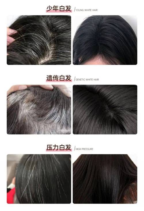白头处理方式：从多方面应对白发困扰