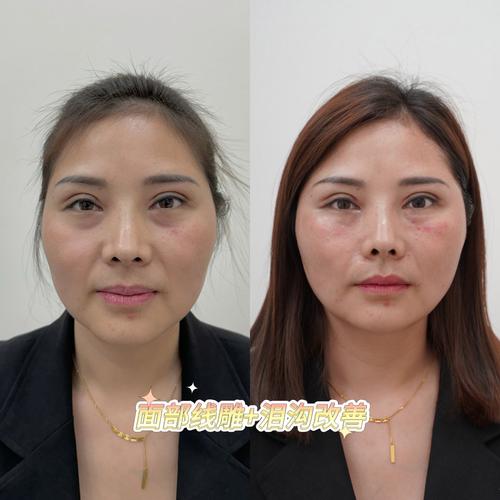 线雕美容介绍与恢复过程