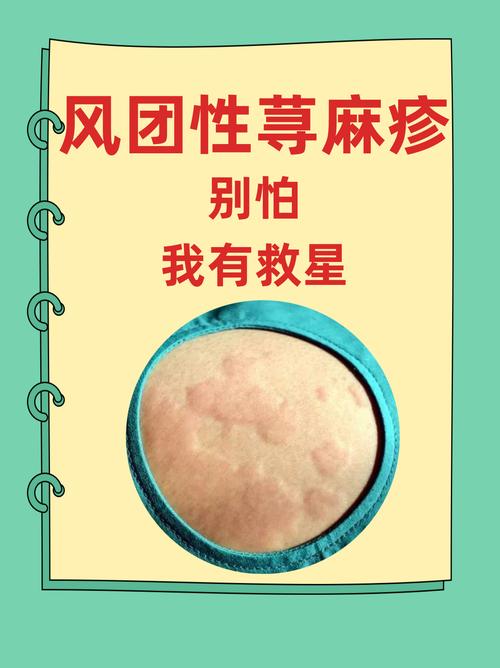 荨麻疹：解析皮肤的“风团之谜”