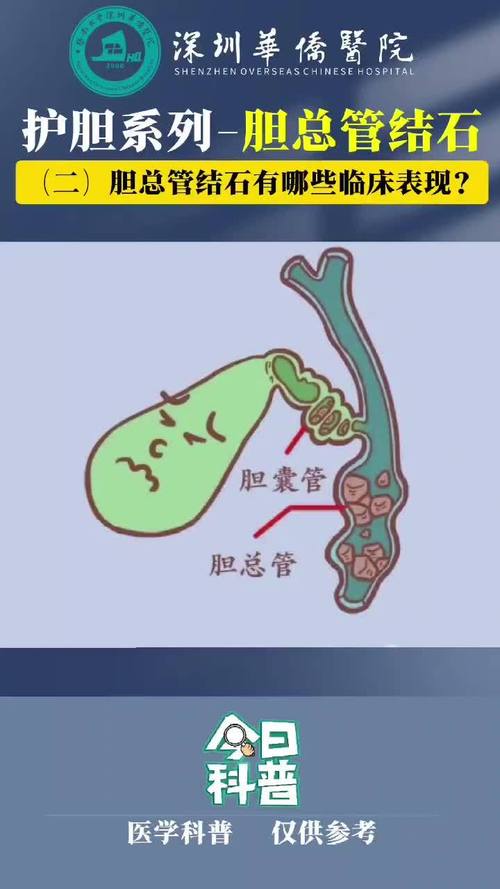 胆结石：隐藏在胆囊里的“定时炸弹”
