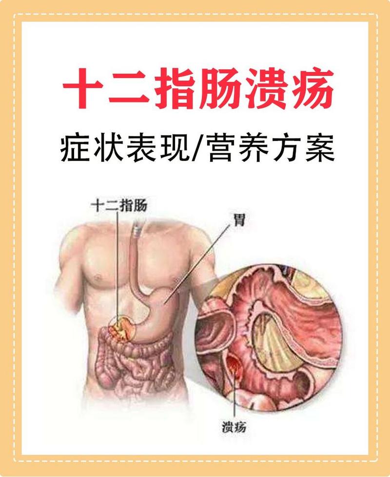以下是关于十二指肠溃疡治疗的详细内容：