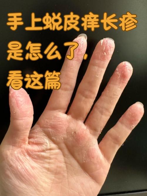 全面解读皮炎：成因、类型、症状与防治全攻略