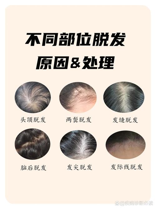 压力性脱发的救星：深度滋养与强韧发丝的护理秘籍