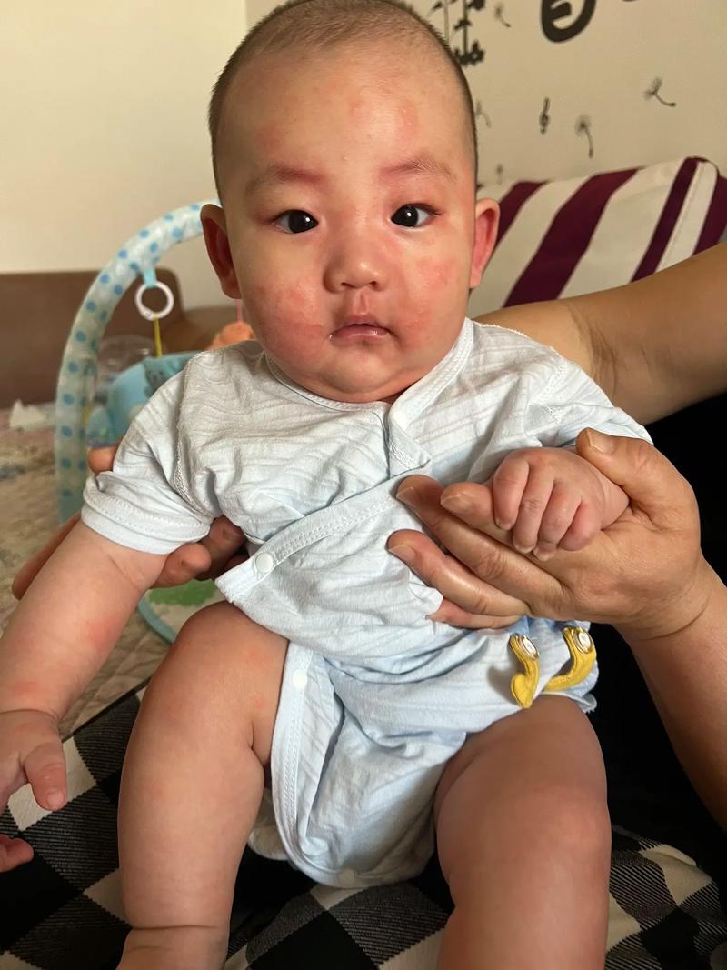 奶粉过敏症状：宝宝健康的“隐形威胁”