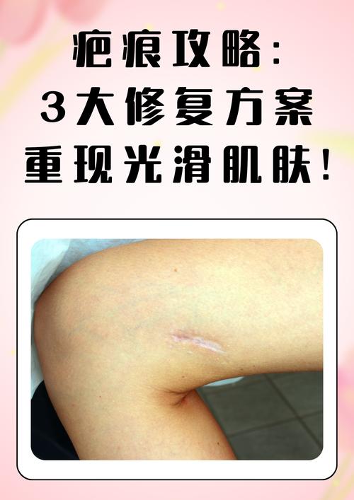 痘疤修复全攻略：重焕肌肤光滑与自信