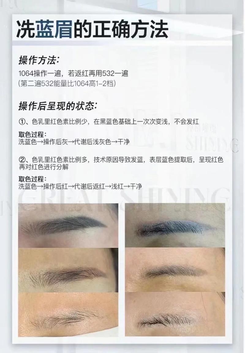 激光洗眉：原理、效果与注意事项