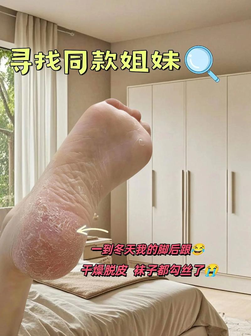 足部干裂修复全攻略：告别干燥，重获娇嫩双足