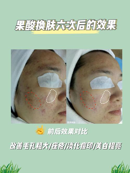 果酸焕肤：解锁肌肤细腻新生密码