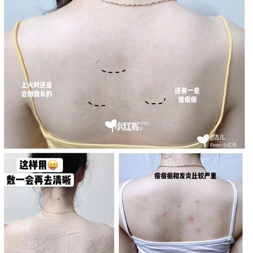 以下是一份关于“肥胖纹修复”的文案，你可以根据实际情况修改和调整。