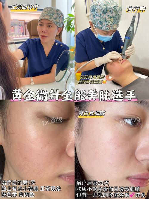 详细阅读:面部黄金微雕:重绽青春光彩的神奇之术 面部黄金微雕:重绽青春光彩的神奇之术