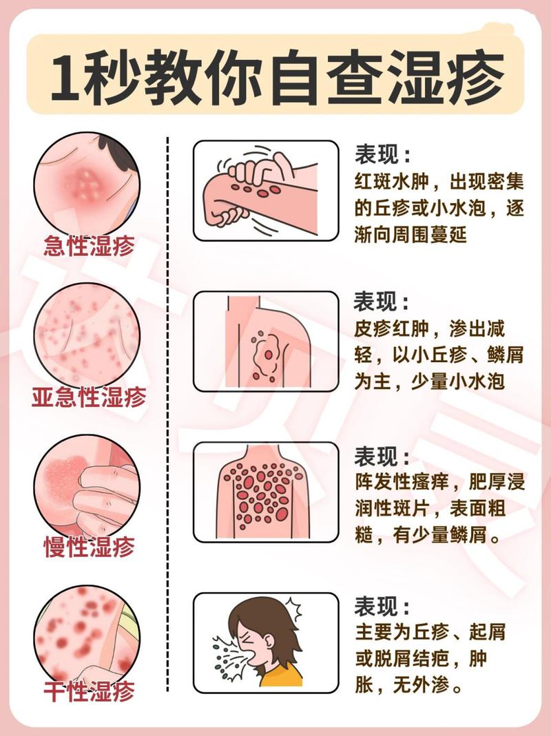 湿疹的治疗与护理：全面指南