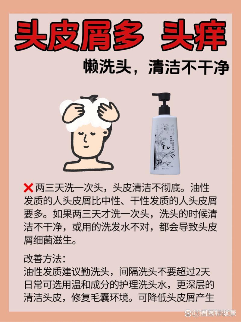 头皮屑产生原因全解析及有效去除方法大揭秘