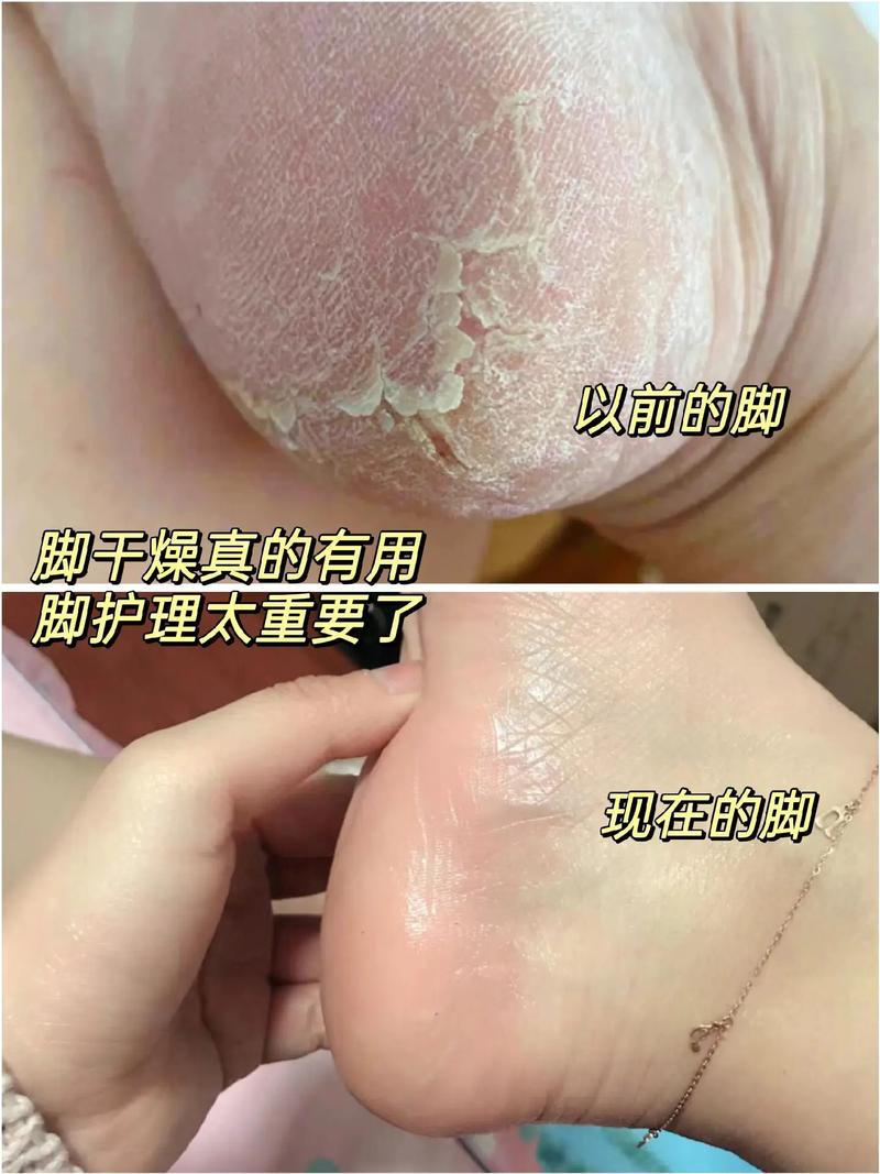详细阅读:足部干裂修复全攻略:重焕双脚水润光泽 足部干裂修复全攻略:重焕双脚水润光泽
