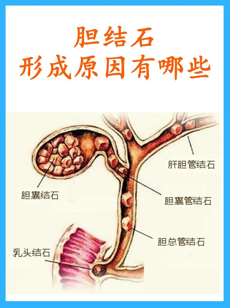 胆结石：症状、诊断与预防全解析