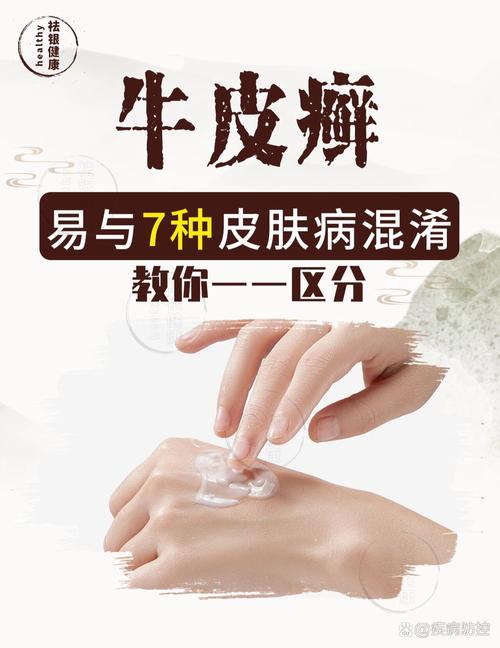 牛皮癣：深度解析治疗与控制策略