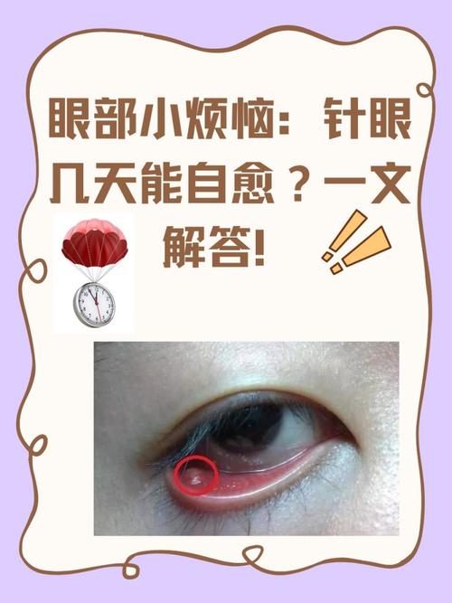 麦粒肿的治疗方法