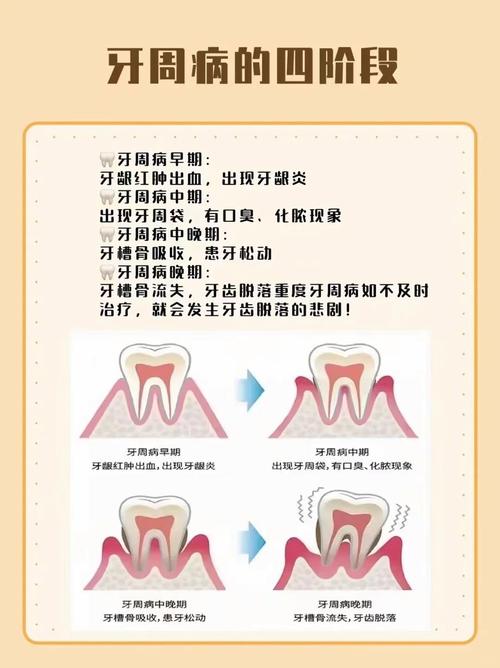 牙周炎：口腔健康的隐形杀手及其防治全攻略