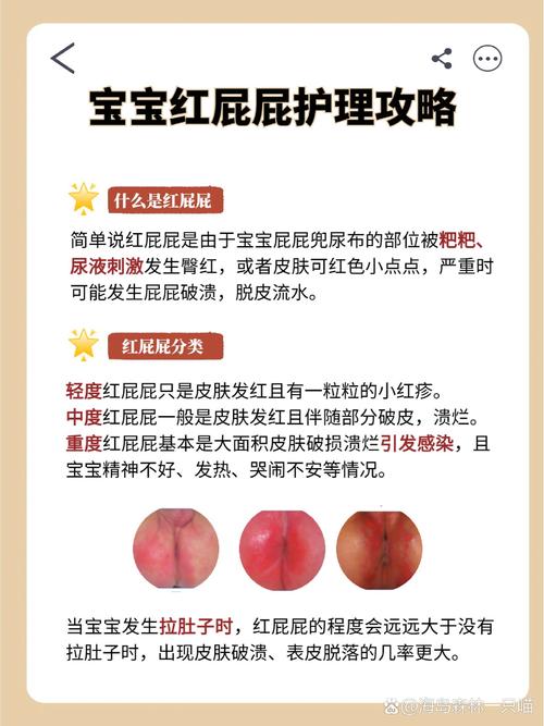 产后护理宝宝红屁屁全攻略：让小屁屁不再“红彤彤”