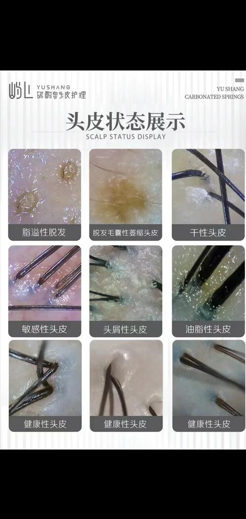头发护理头皮清洁产品：守护头皮健康的秘诀