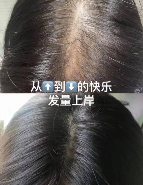 头发护理压力性脱发的“救星”——发膜，重焕浓密秀发