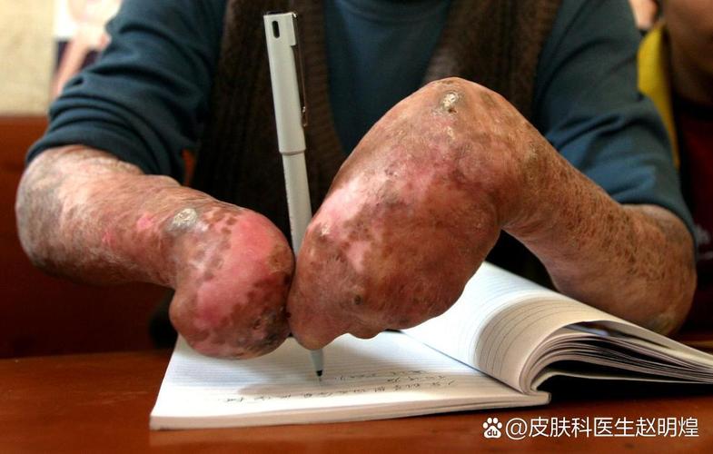 吸烟对皮肤的损害表现