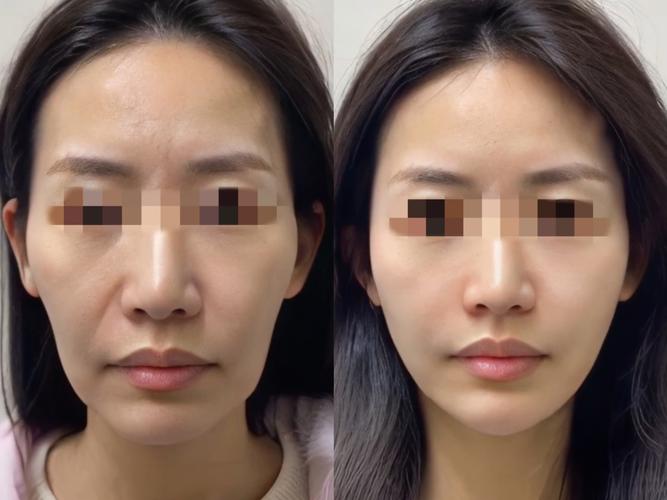 线雕美容：焕发年轻光彩，重现肌肤紧致弹性
