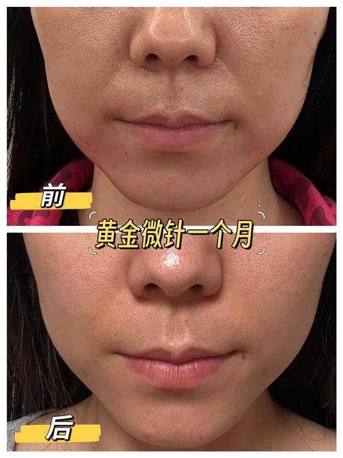 详细阅读:黄金微针美容效果与过程 黄金微针美容效果与过程