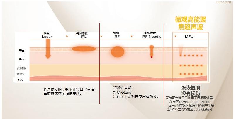 聚焦超声减脂技术原理：深度解析与科学依据