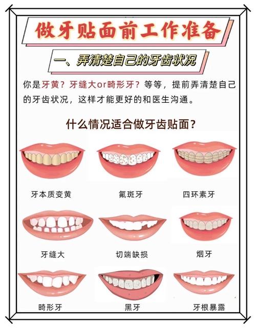 详细阅读:牙齿贴面美容知识:重塑微笑,从“齿”开始 牙齿贴面美容知识:重塑微笑,从“齿”开始