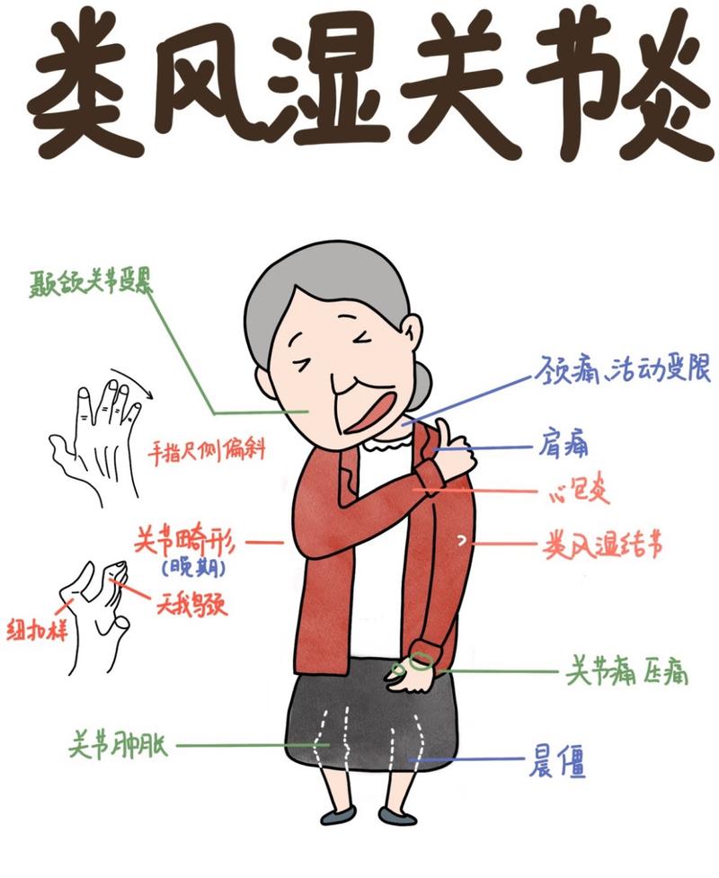 详细阅读:类风湿性关节炎:了解、应对与预防 类风湿性关节炎:了解、应对与预防