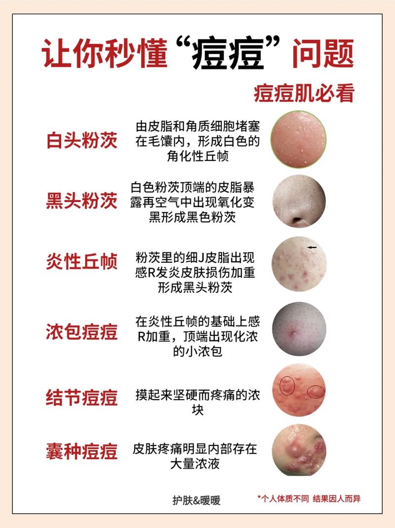 详细阅读:痤疮类型及应对 痤疮类型及应对