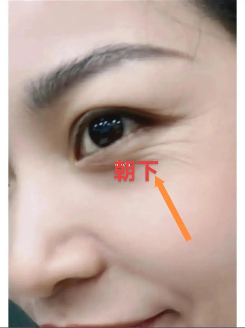 详细阅读:鱼尾纹消除技巧全攻略:重现双眸年轻光彩 鱼尾纹消除技巧全攻略:重现双眸年轻光彩