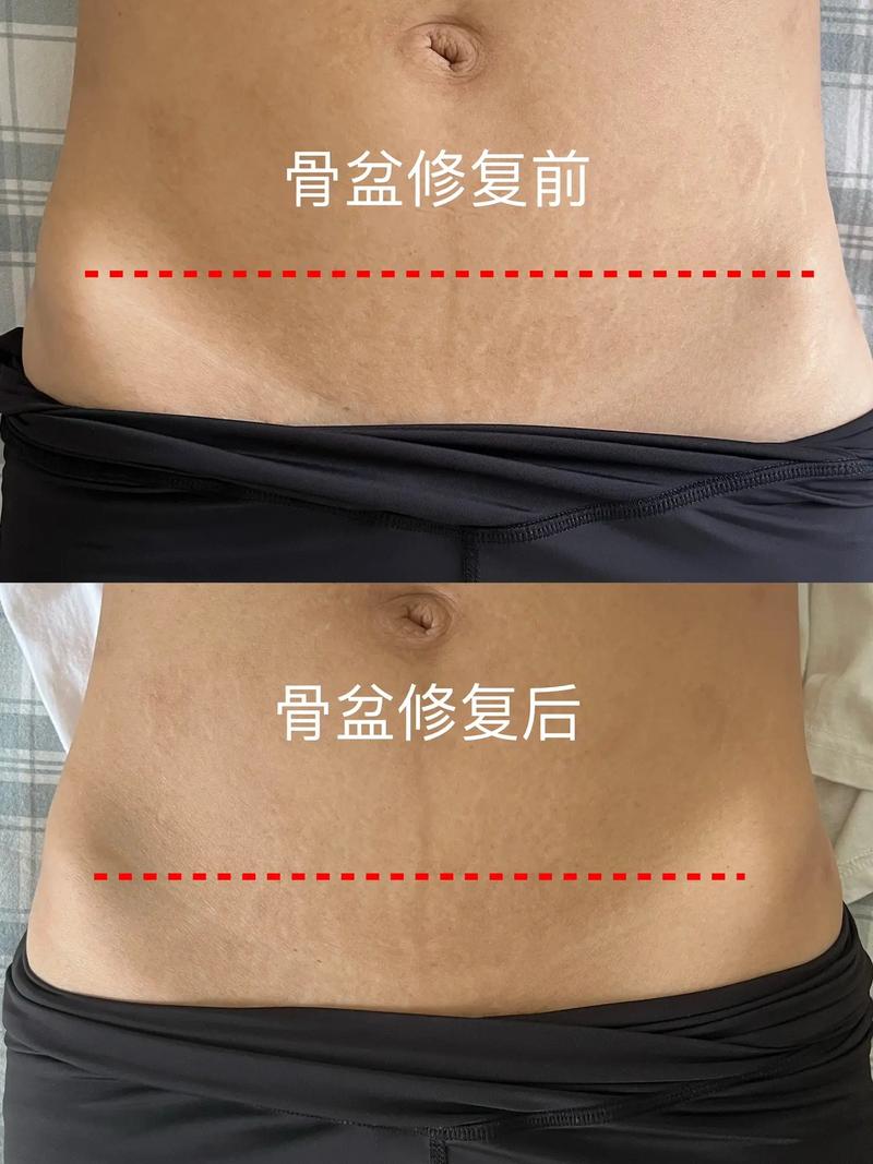 详细阅读:产后骨盆修复带的真相 产后骨盆修复带的真相