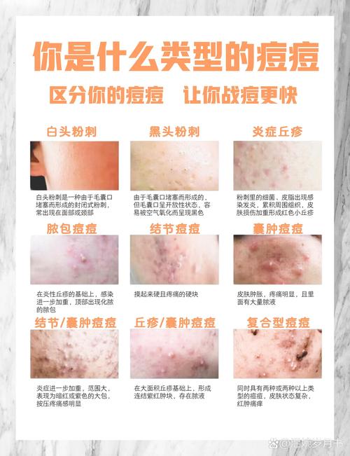 肌肤祛痘消炎全攻略：科学战痘，重拾肌肤光彩