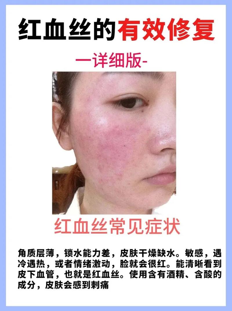 红血丝肌肤修复：重焕肌肤健康光彩的科学之旅