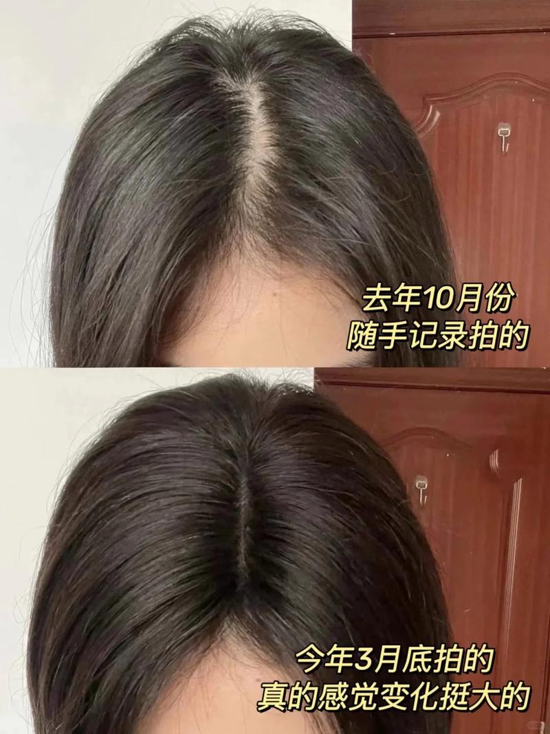 详细阅读:头发增发:重拾自信,焕新生活 头发增发:重拾自信,焕新生活