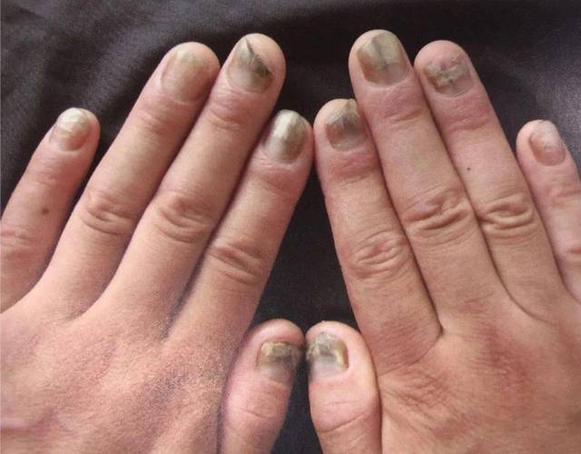 详细阅读:灰指甲的全面治疗指南:告别顽固真菌,重拾健康指甲 灰指甲的全面治疗指南:告别顽固真菌,重拾健康指甲