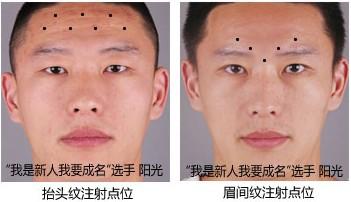 详细阅读:全面解析抬头纹预防措施:守护青春额头的奥秘 全面解析抬头纹预防措施:守护青春额头的奥秘