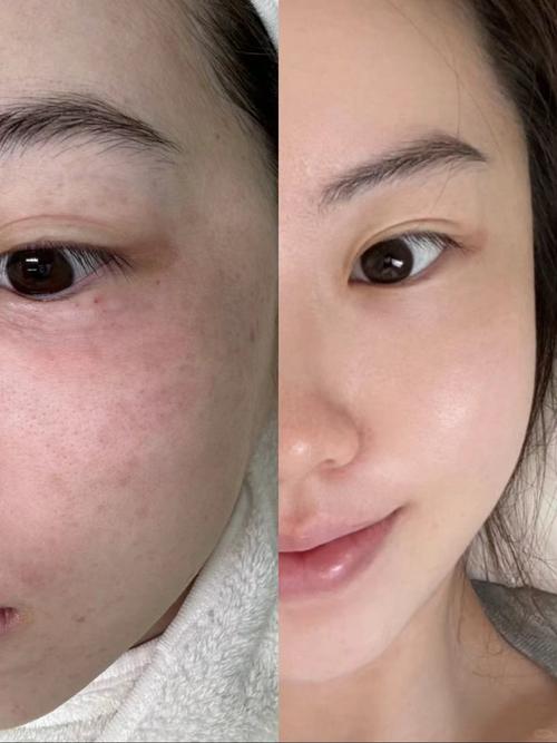 详细阅读:水光针与水光枪:皮肤美容的两大神器对比 水光针与水光枪:皮肤美容的两大神器对比