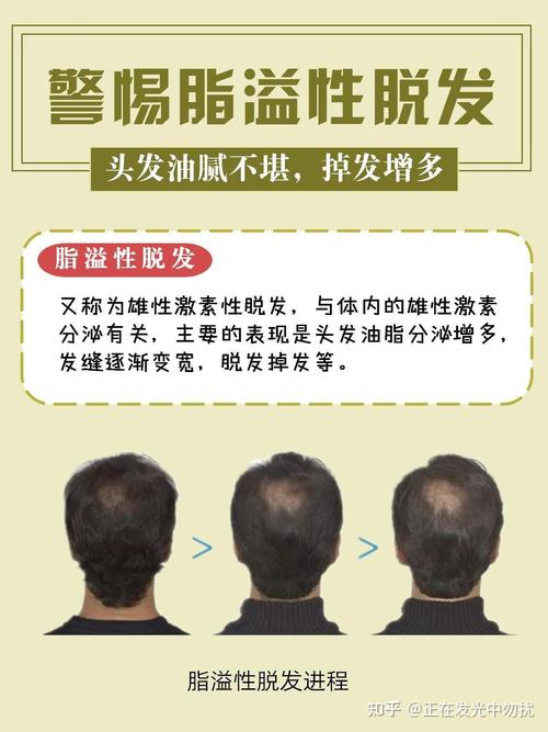 详细阅读:雄激素性脱发的全面调理指南 雄激素性脱发的全面调理指南