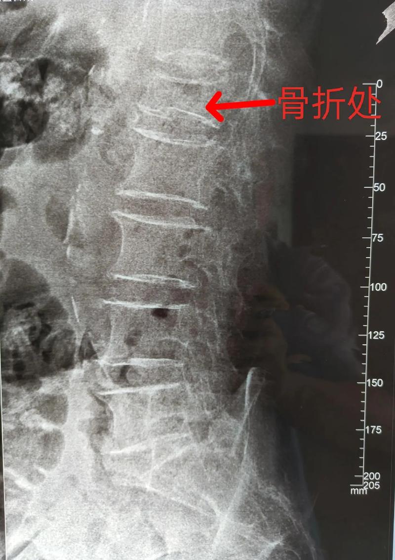 详细阅读:骨质疏松:隐匿的“骨”折 骨质疏松:隐匿的“骨”折